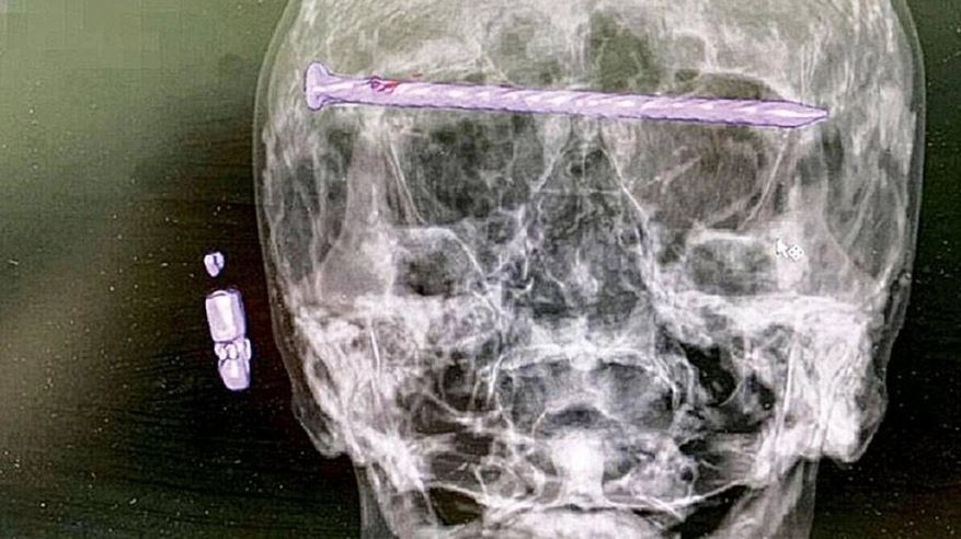 A “thunderbolt” inside a man’s skull surprises doctors