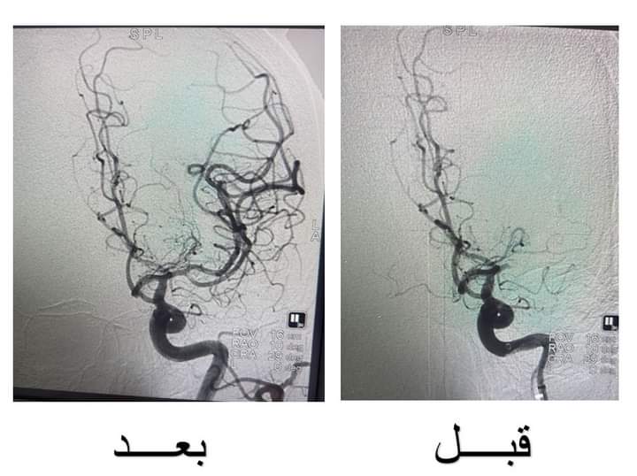 المستشفى التخصصي يعالج جلطة دماغية حادة خلال عشرين دقيقة فقط 